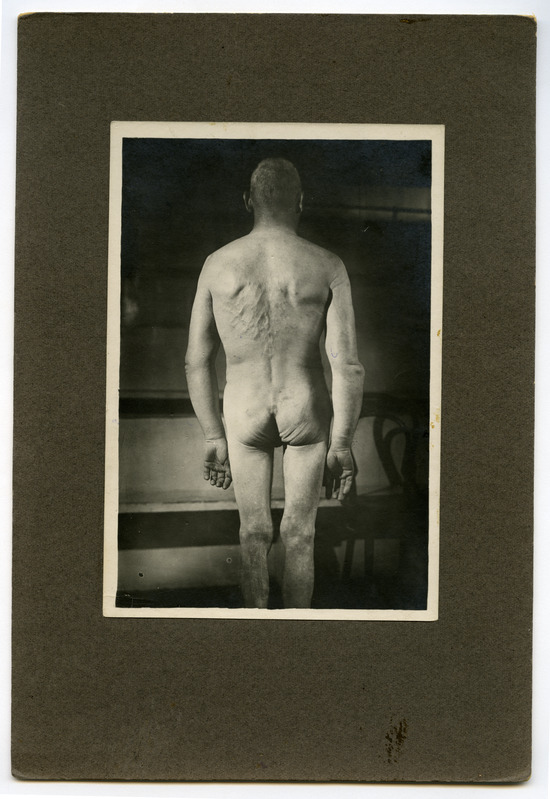 Tumor mediastini, Stoke'sche Kragen
