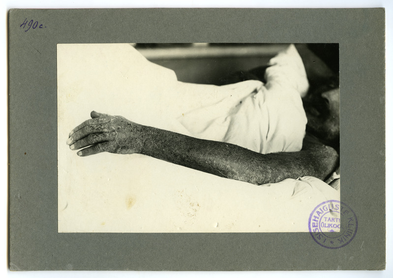 Salvarsandermatitis