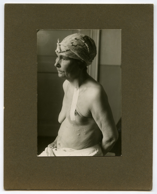 Ca(rcinoma) mammae, metastatibus cutis