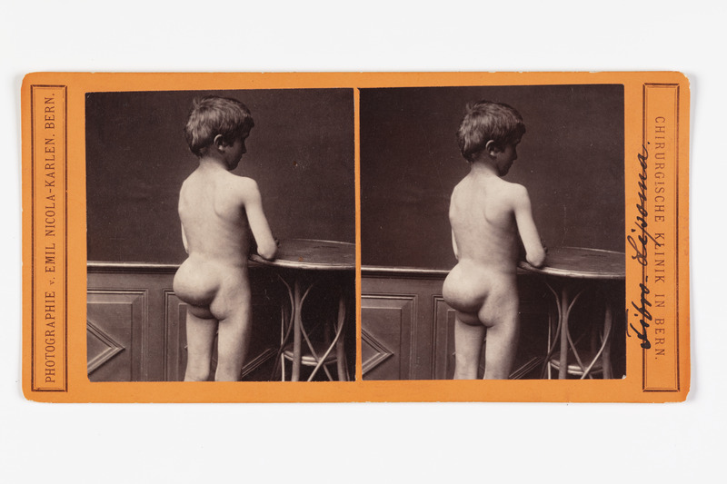 Stereofoto haigusjuhtumist. Fibro-lipoma.