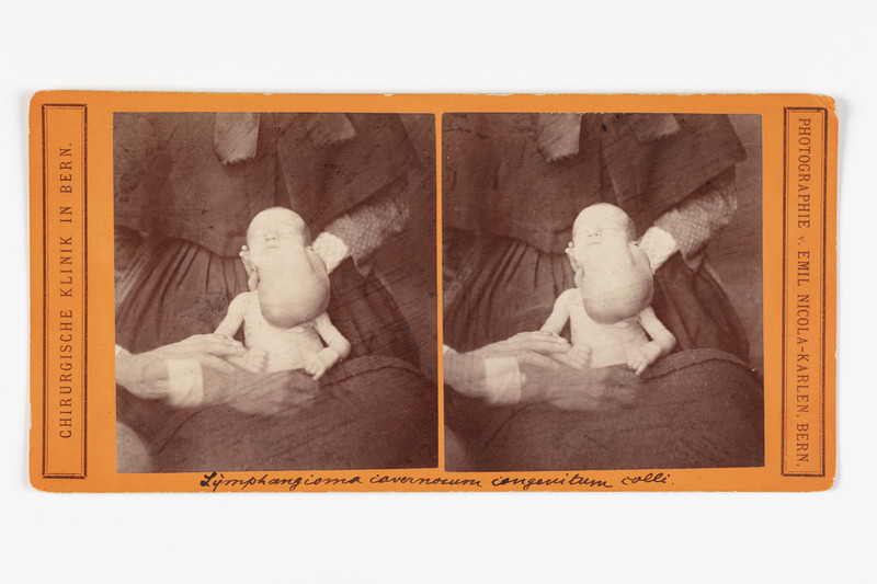 Stereofoto haigusjuhtumist. Lymphangioma covernosum congentium colli.