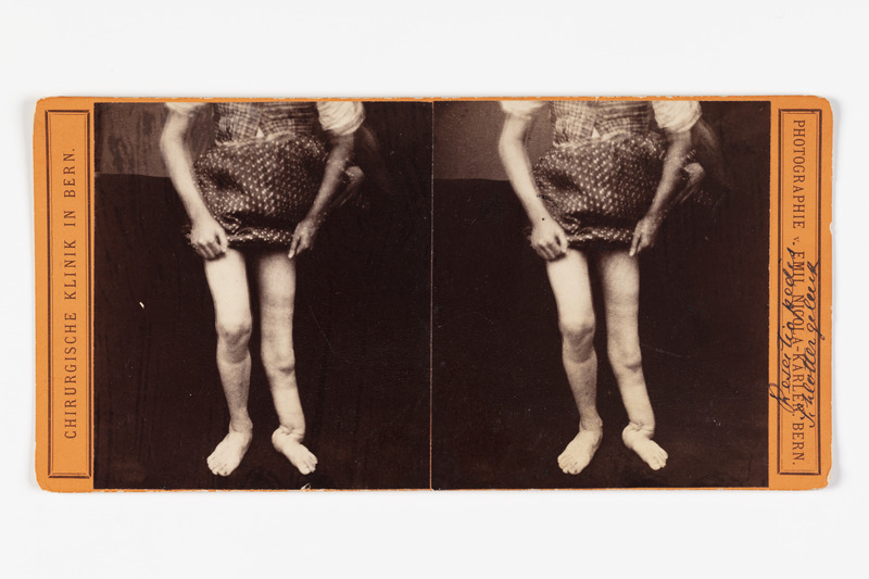 Stereofoto haigusjuhtumist. Resectia pedis Schlottergeluck.