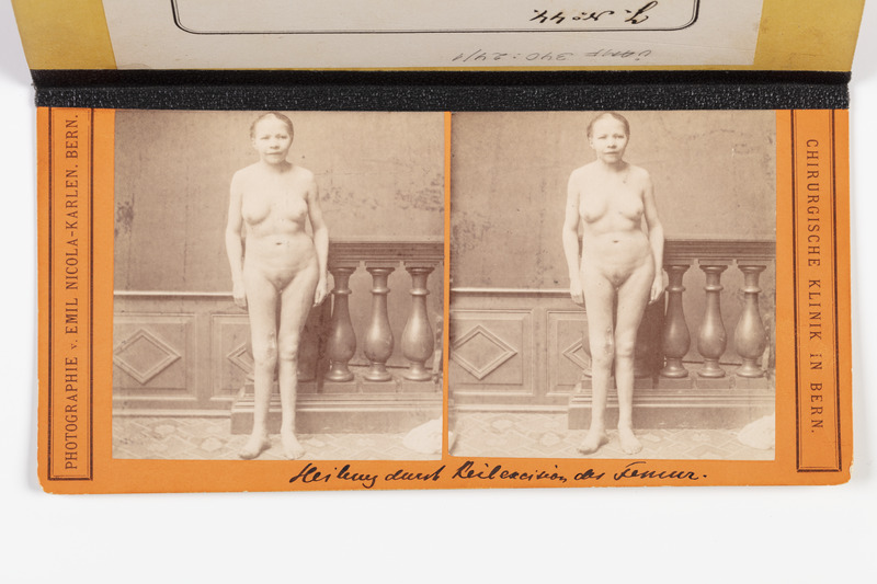 Stereofoto haigusjuhtumist. Genu valgum. Nach d. Operation.