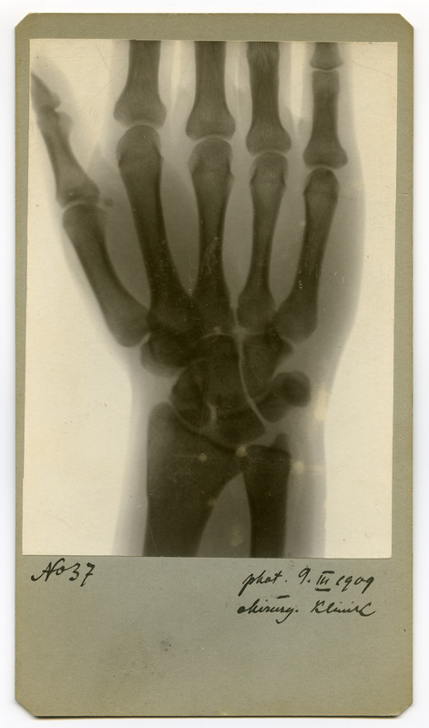 Röntgenfoto haigusjuhtumist. Hand.