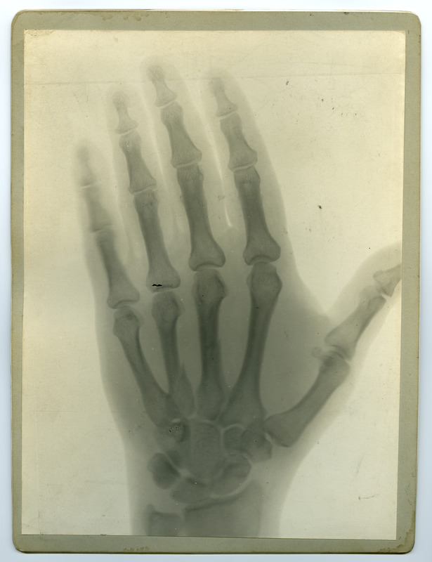 Röntgenfoto haigusjuhtumist. Käsi.