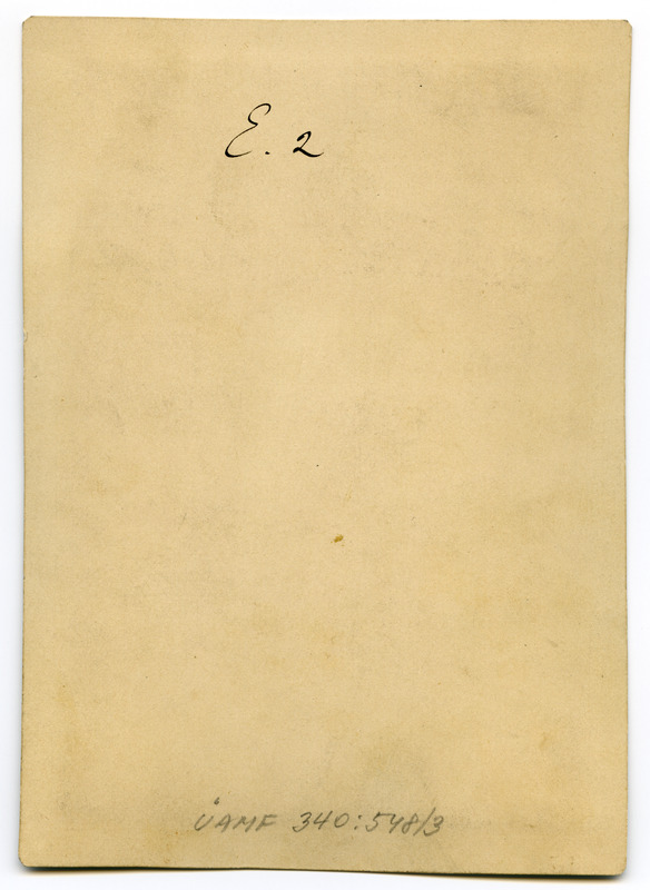 Foto haigusjuhtumist. Verbrennungsnarben in... Põletus.