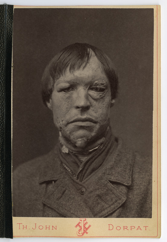 Foto haigusjuhtumist. Correction d. Ectropien am linken ... Transplantation. Põletus. Patsient Pillak, Jaan, 20.a.