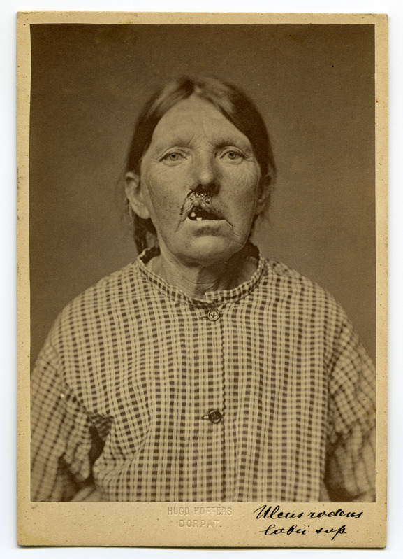 Foto haigusjuhtumist. Ulcus rodens der Oberlippe. Kasvaja. Patsient Kranberg, Mai, 59.a.
