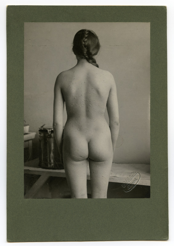 Foto haigusjuhtumist