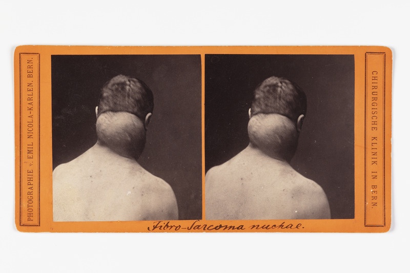 Stereofoto haigusjuhtumist. Fibro-Sarcoma nuchae...