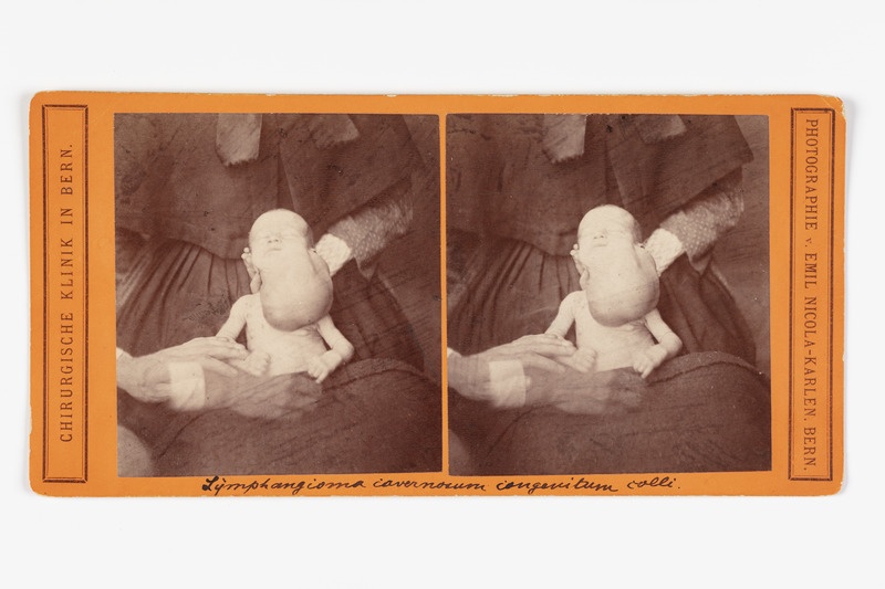 Stereofoto haigusjuhtumist. Lymphangioma covernosum congentium colli.