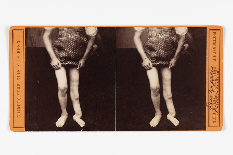 Stereofoto haigusjuhtumist. Resectia pedis Schlottergeluck.