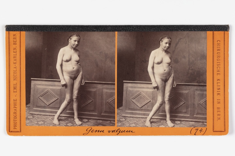 Stereofoto haigusjuhtumist. Genu valgum. Vor d. Operation.