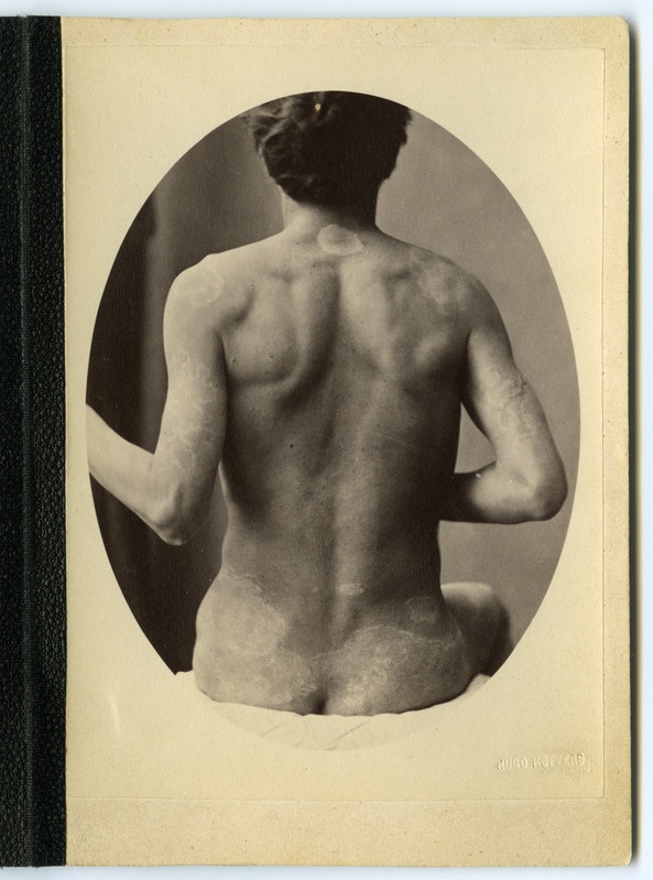 Foto haigusjuhtumist. Lepra anaesthetica. Leepra. Patsient Kriwitz, Friedrich, 25.a.