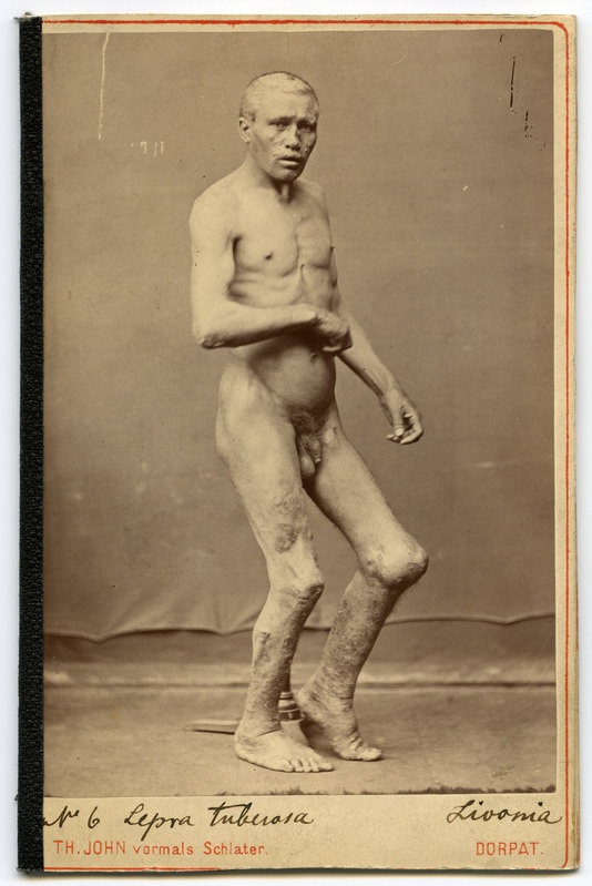 Foto haigusjuhtumist. Lepra tuberosa. Leepra. Patsient Lowwi, I.