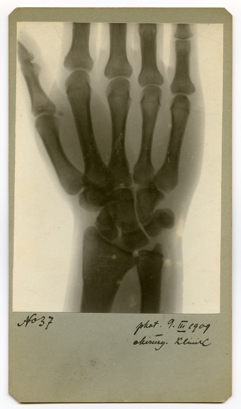 Röntgenfoto haigusjuhtumist. Hand.