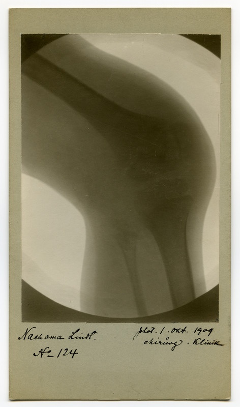 Röntgenfoto haigusjuhtumist. Põlv.  Patsient Lindt, Nachama.