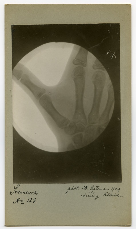 Röntgenfoto haigusjuhtumist. Käsi. Patsient Sresnewski.