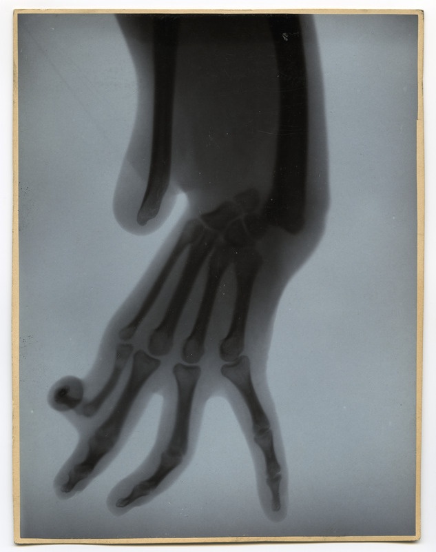 Röntgenfoto haigusjuhtumist. Defect d. radi... Daumen.