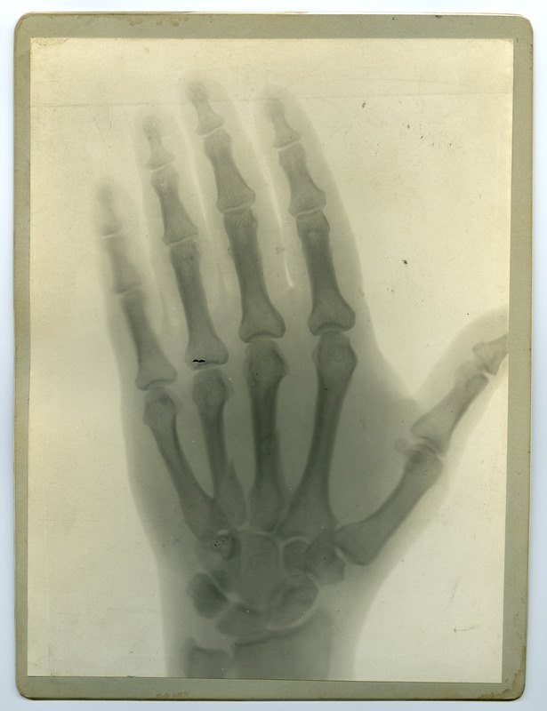 Röntgenfoto haigusjuhtumist. Käsi.