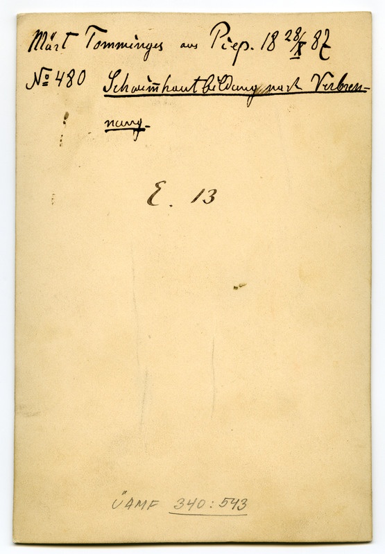 Foto haigusjuhtumist. Schwimmhautbildung nachVerbrennung. Põletus. Patsient. Tommingas, Märt, 18.a., Piep.