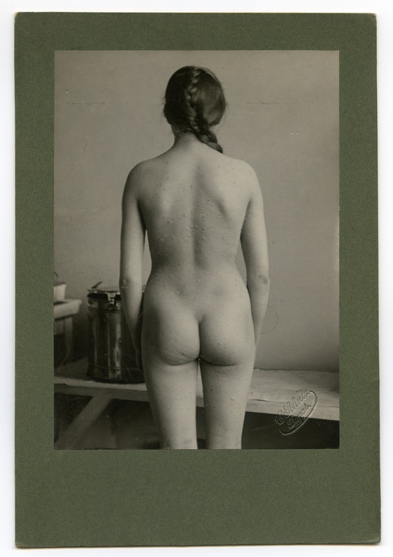 Foto haigusjuhtumist