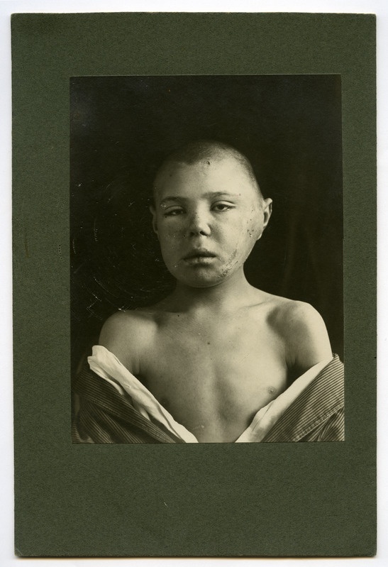 Parothitis purulenta