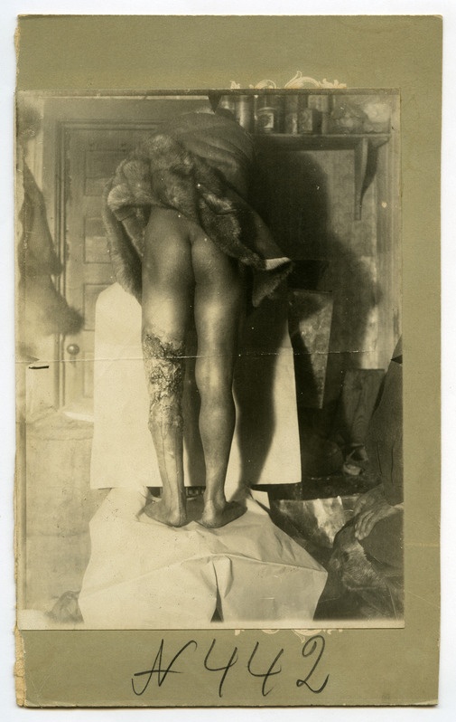Syphilis III