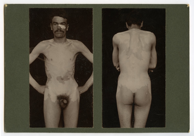 Vitiligo
