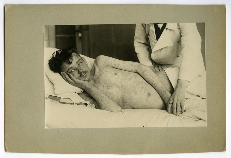 Gangräena pulmonis dextri post pneumoniem. Erythema septicum