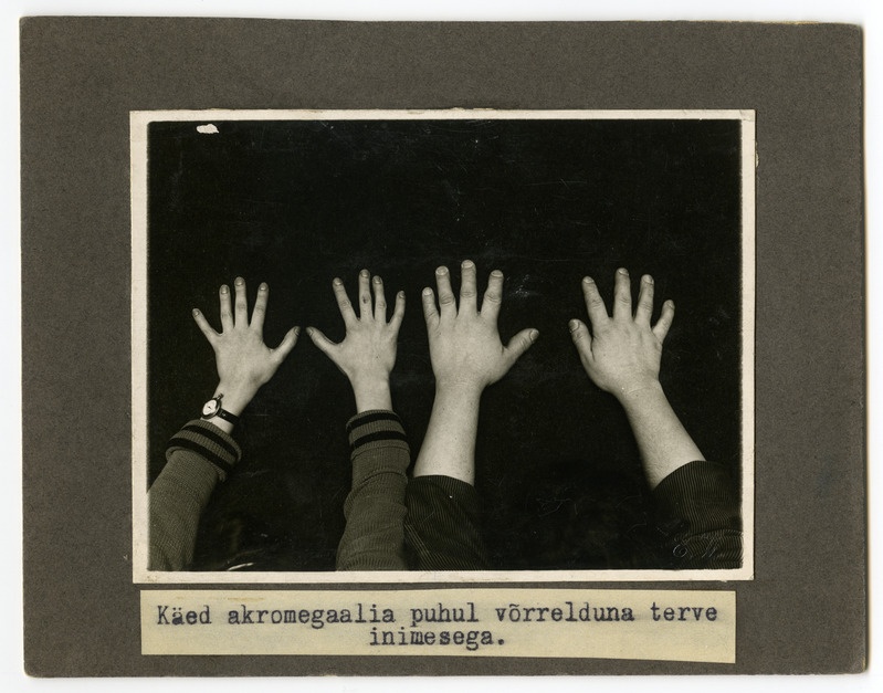 Acromegalia