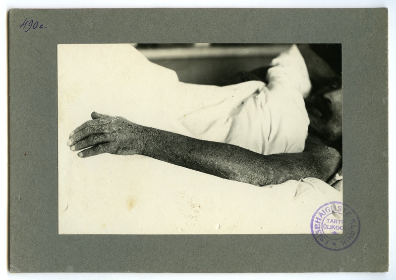 Salvarsandermatitis