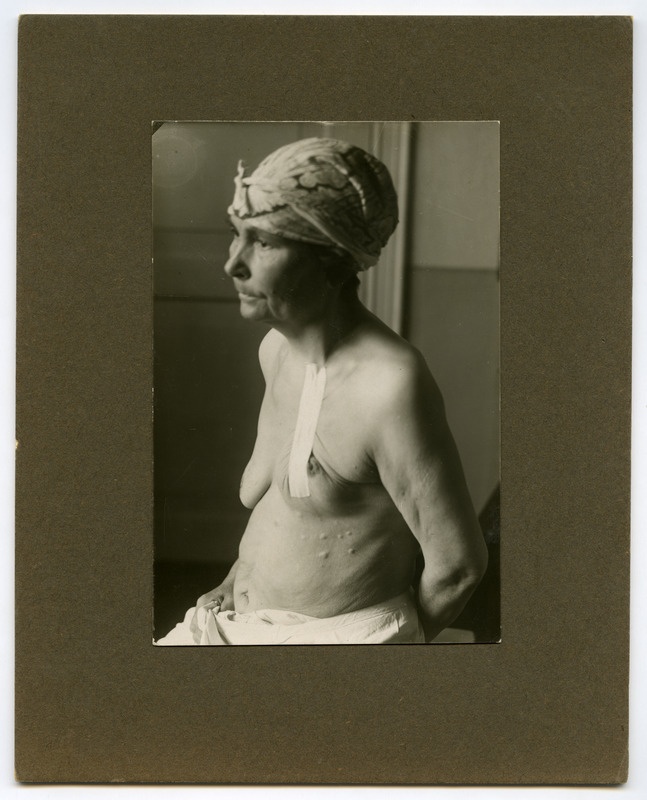 Ca(rcinoma) mammae, metastatibus cutis