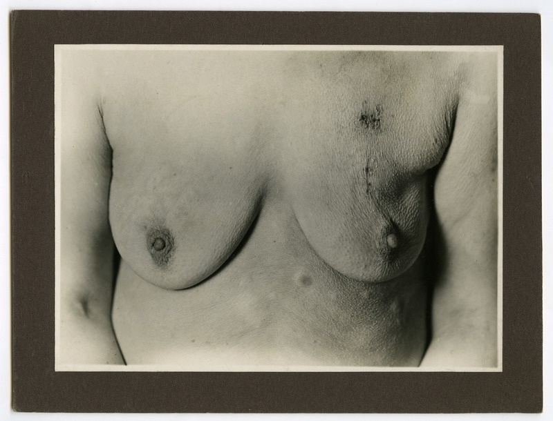 Ca(rcinoma) mammae, metastatibus cutis